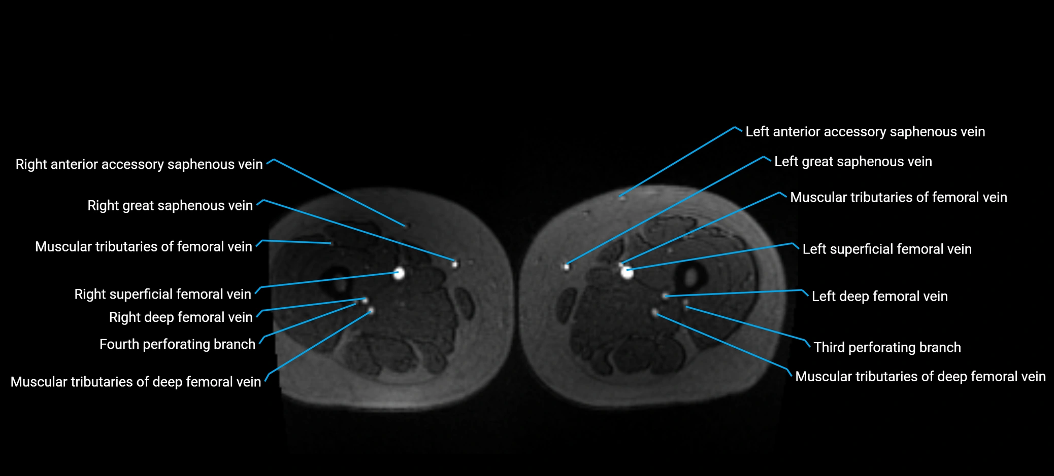 MRV abdomen pelvis & lower limb axial cross sectional anatomy labelled MRI image 260 (1).webp